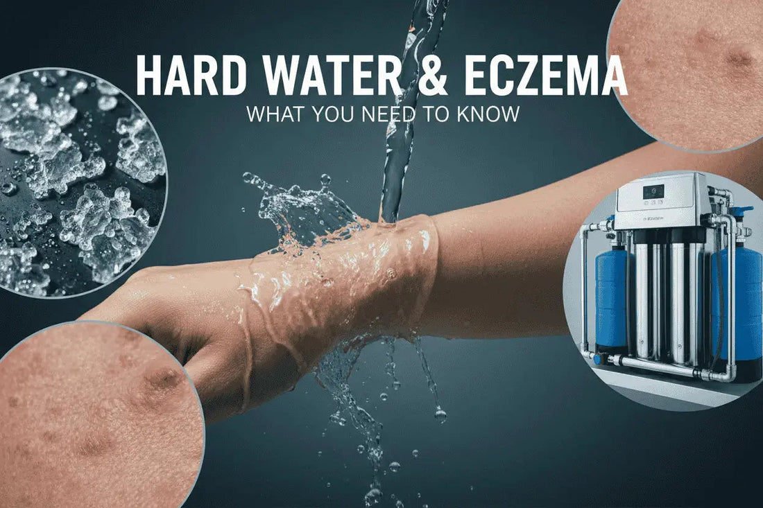Dealing with Eczema: Understanding Hard Water’s Impact and Effective Treatments in 2026 - Clean River Water Store